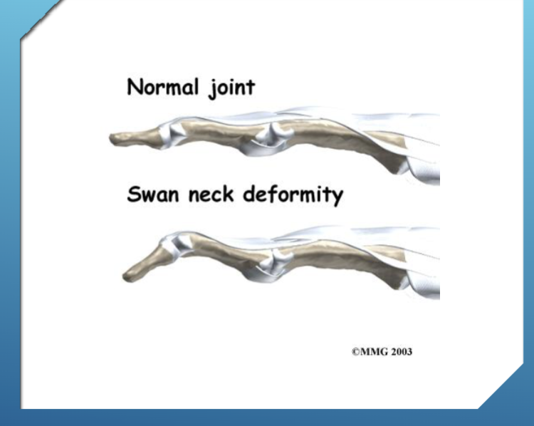 <p>Flexion of MCP, hyperextension of the PIP, and flexion of the DIP</p>