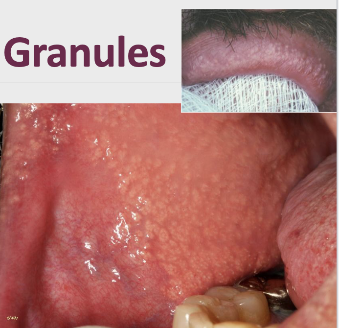<p>Clusters of “ectopic” sebaceous glands</p>