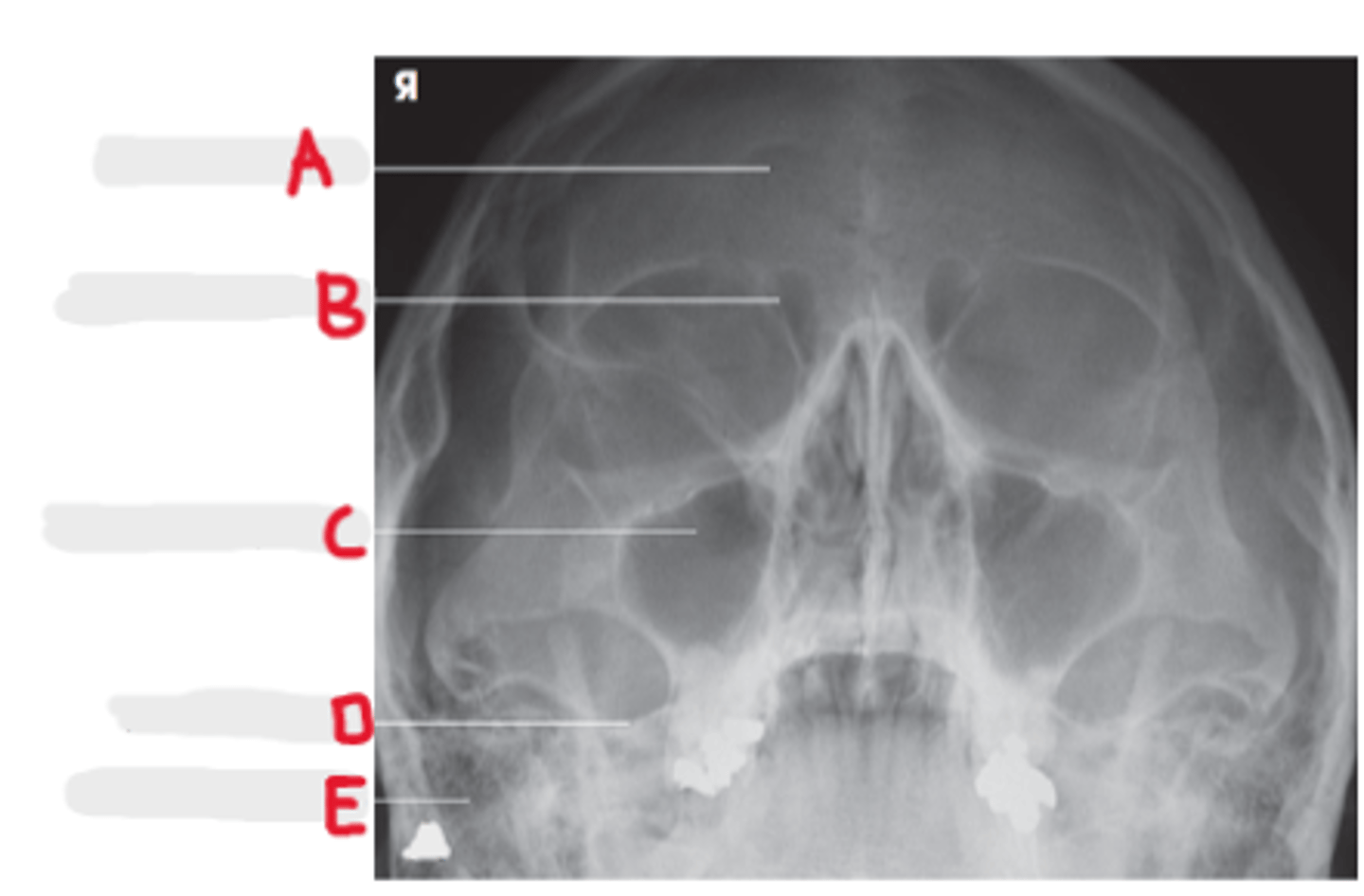 <p>What sinuses are best demonstrated on the Parietoacanthial (Waters Method)?</p>