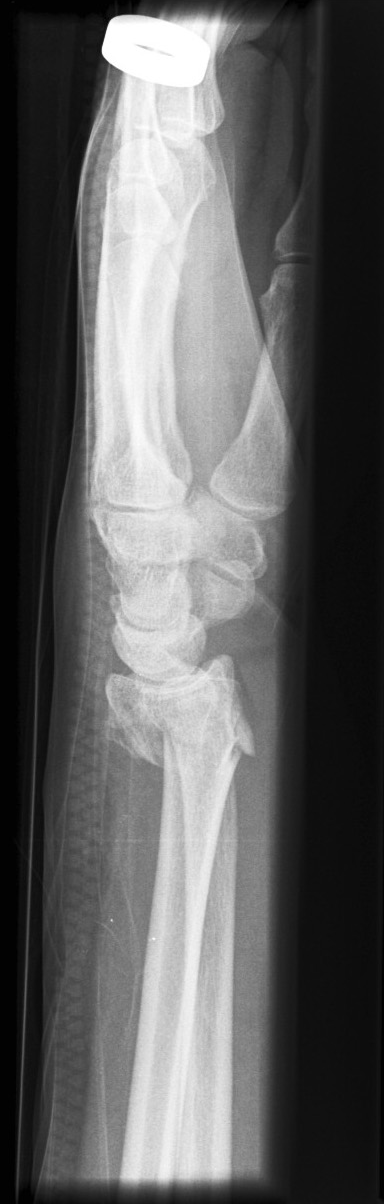 <p>Describe the abnormality demonstrated.</p>