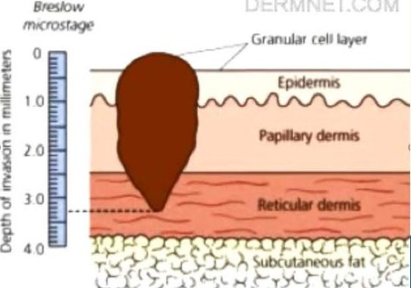<p>Depth of invasion of melanoma from the granular layer of the epidermis, the best predictor of 5-year survival rates</p>