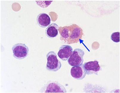 <p>CSF cytospin slide, what is the blood cell indicated in the photo?</p><p>Segmented neutrophil</p><p>Monocyte</p><p>Eosinophil</p><p>Macrophage </p>