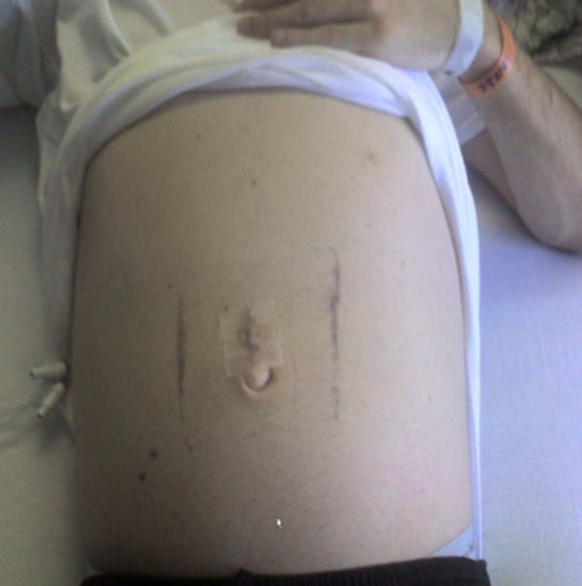 <p>usually has an abdominal presentation, most often with massive disease and ascites</p>