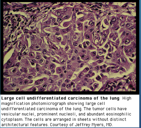 <p>-poorly differentiated non-cell carcinoma that are not classified by light microscopy</p><p>-prognosis closely resemble adenocarcinoma</p><p>-frequently shows necrosis</p>
