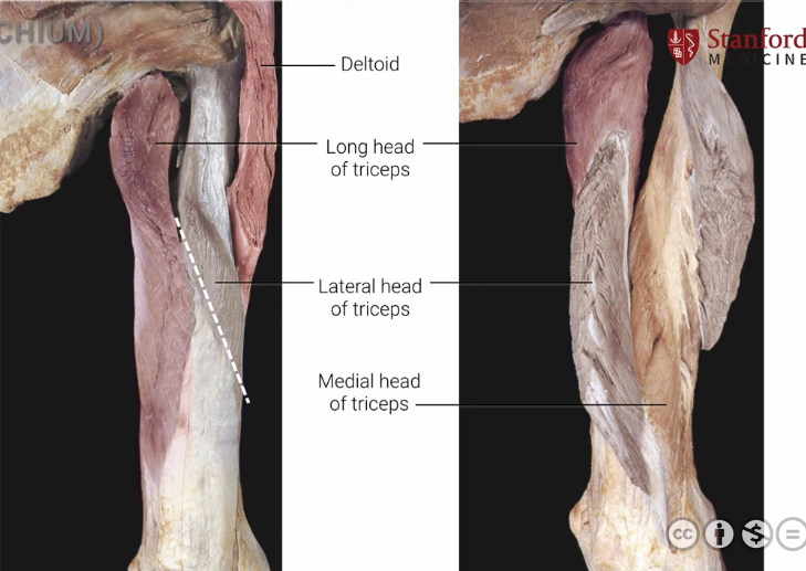 <p>Origin: Infraglenoid tubercle (long head), Lateral andd posterior diaphysis of humerus(Lateral head)<br>Insertion: Olecranon process of ulna<br>Action: Extends elbow and shoulder, assists in adduction.</p>