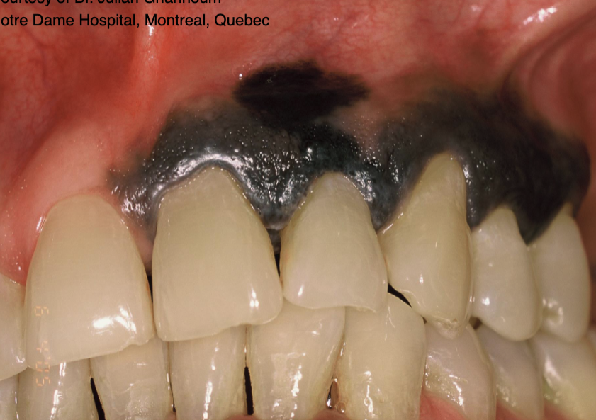 <p>palatal mucosa + max gingiva&nbsp;</p>