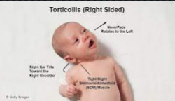 Torticollis