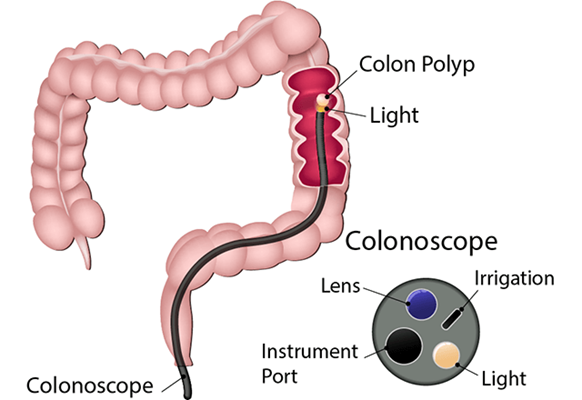 <p><strong>Visual examination of the sigmoid colon </strong><span style="color: purple"><em>(đại tràng sigma)</em></span></p><p>A. Colonoscopy<br>B. Sigmoidoscopy<br>C. Gastroscopy<br>D. Laparoscopy</p>
