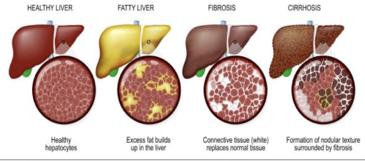 <ul><li><p>extensive fibrosis → stiffens blood vessels and distorts internal structure&nbsp;</p></li><li><p><strong>severe function impairment</strong> → malfunction of OTHER ORGANS&nbsp;</p></li><li><p>often <strong>fatal</strong>, but can stabilize with abstinence&nbsp;</p></li></ul><p></p>