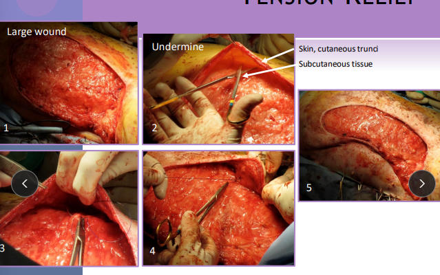 <ul><li><p><strong>Undermining: </strong>Tension relief, simple, max elastic potential</p><ul><li><p><span style="color: red;">separate skin + panniculus from SC tissue</span></p></li><li><p><span style="color: red;">Delayed wound healing</span></p></li></ul></li><li><p><strong>Walking sutures</strong>: Tension relief, move skin / tack down, obliterate dead space, distribute tension</p><ul><li><p>Stretch skin over defect</p></li><li><p><span style="color: red;">Use multi rows of suture anchored in fascia and dermis</span></p><ul><li><p><span style="color: red;">Do not penetrate the skin surface</span></p></li></ul></li></ul></li><li><p><strong>Tension Relief Sut</strong>: cruciate(skin), horizontal/vertical mattress (fascia/deep tissue), far-near-near-far (support)</p><ul><li><p><strong><u>Limited </u></strong>effect</p></li></ul></li></ul><img src="https://knowt-user-attachments.s3.amazonaws.com/6c747388-3ea8-4a01-be9e-9c28a236364a.png" data-width="25%" data-align="center"><ul><li><p><strong>Stents & quills: </strong>Tension relief</p><ul><li><p>red rubbers</p></li></ul></li></ul><p></p>