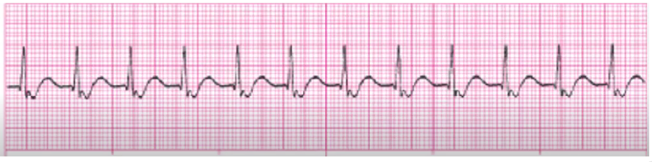 <p>rate 101-180</p><p>stop meds if they’re the cause</p><p>treat as SVT - slow HR w adenosine</p><p>amiodarone, Ca Channel blockers, BBs</p>