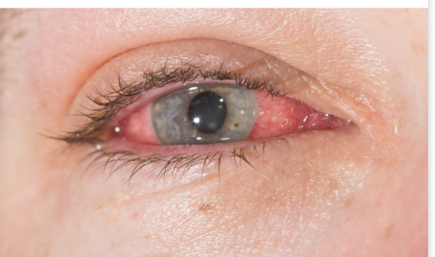 <p>23 y/o male presents to the ED for eye pain. On physical exam, you note NORMAL visual acuity, pain with EOM, and a SUPER RED EYE!! What is your treatment plan?</p>