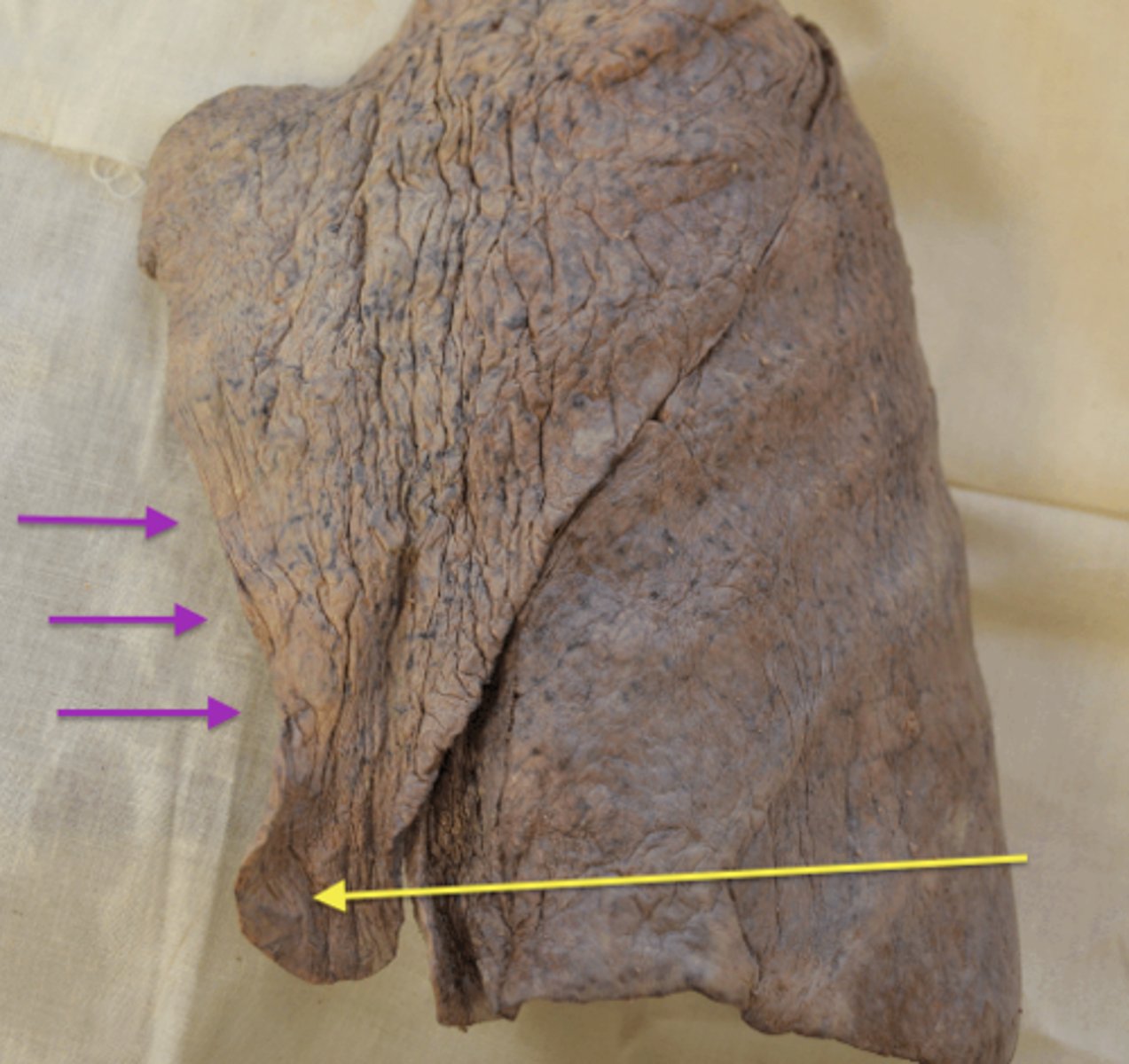 <p>-tongue-like</p><p>-on superior lobe of left lung</p><p>-inferior</p>