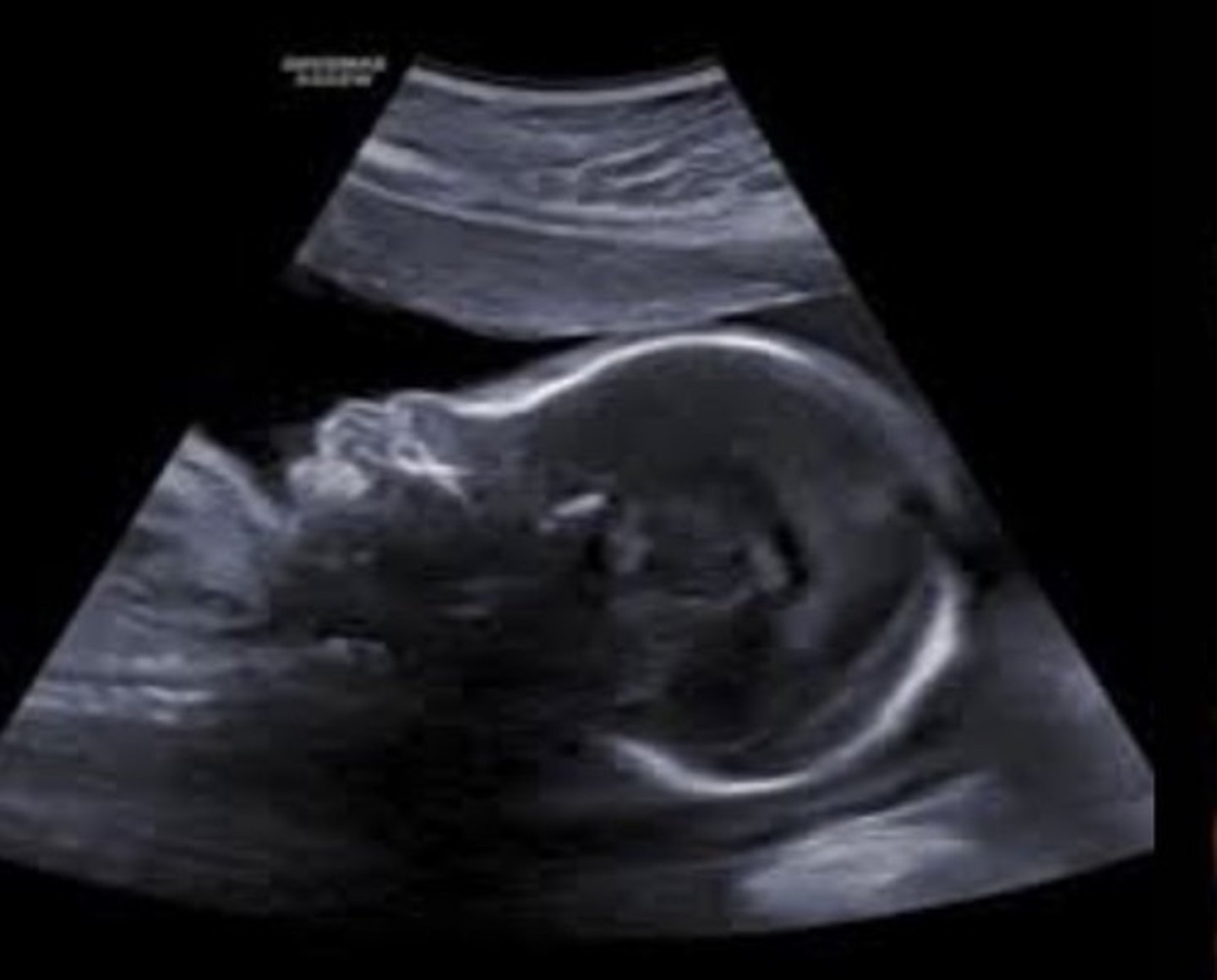 <p>Jaw and cheekbones do not grow well</p><p>Depressed or absent nasal bridge</p><p>Eyes and forehead appearing to bulge</p>