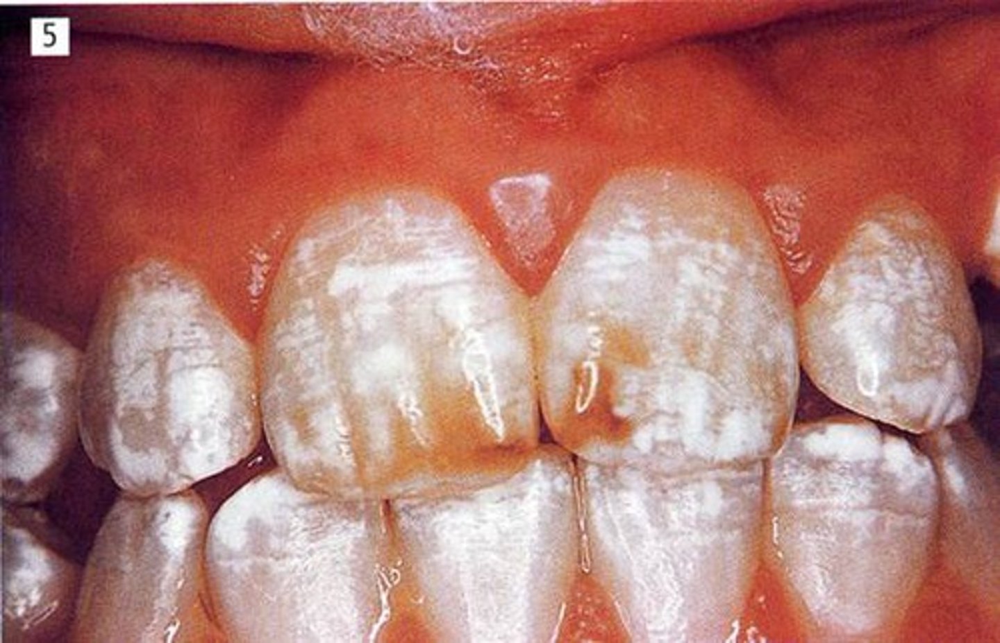 <p>too much F- exposure</p><p>competes with calcium from hydroxyapatite and form fluoroapatite which weakens enamel } all during tooth formation</p>