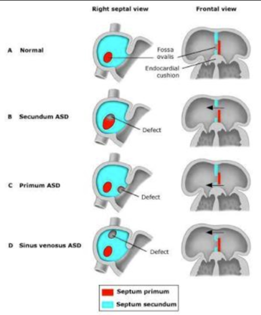 <p>Primum: defect in lower portion of the atrial septum</p><p>Secundum: defect in the middle portion of the atrial septum (most common)</p><p>Sinus Venosus: defect in the high septum near the SVC</p>