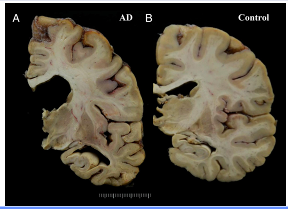 <p>What are three features of the cortex of someone with Alzheimer’s </p>