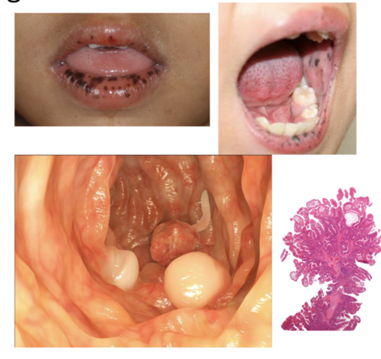 <p>mucocutaneous hyperpigmentation that presents as pigmented macules on lips and buccal mucosa</p><p>-autosomal dominant</p><p>-presents in 1st-3rd decade</p><p>-can fade after puberty</p><p>-can also have lesions on fingers, soles, &amp; around the eyes</p><p>-associated with polyps of the GI tract **</p><p>-risk for multiple cancers</p>