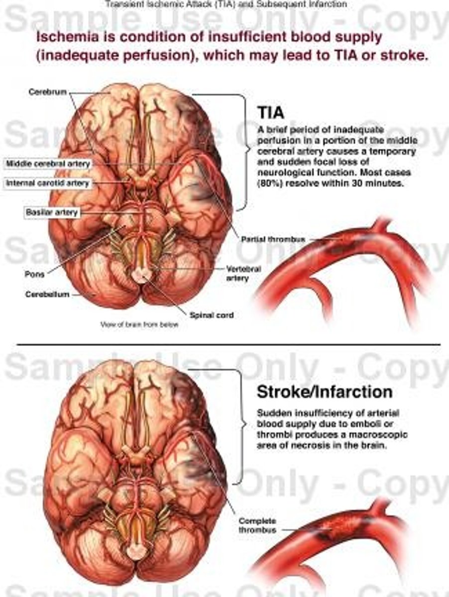 <p>Form of plasticity. Following damage through trauma, the brain's ability to redistribute/transfer functions performed by damaged areas to other, undamaged areas.</p>