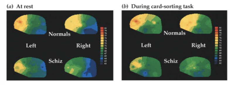 <p>exhibit some cognitive deficits - level of cognitive functioning is #1 predictor of long term outcome (better function = better prognosis)</p><ul><li><p>severity of psychotic symptoms not related to severity of deficits</p></li><li><p>many impaired functions mediated by prefrontal cortex/hippocampus</p></li><li><p>schizophrenia patients showed minimal PFC activity increase when performing Wisconsin Card Sort task, unlike controls - other brain regions similarly activated</p></li><li><p>current medication mutes cognition, which makes it hard to function</p></li></ul><p></p>