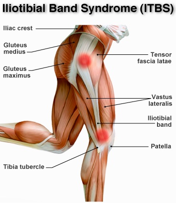 distance runners and cyclist
- constantly moving knee from flexion to extension. Running injuries occurs mostly on the right hand side. (running at a slight angle putting additional pressure on the right side). The force exerted on you during run. causes pressure on the outside leg. 
•Mostly due to abnormal alignment in the lower extremity