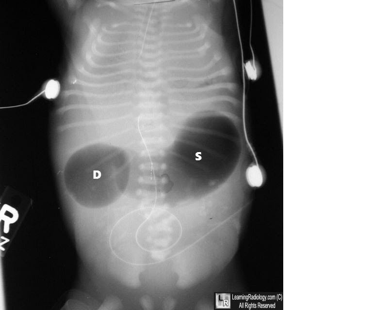 <p>What pathology is shown here?</p>