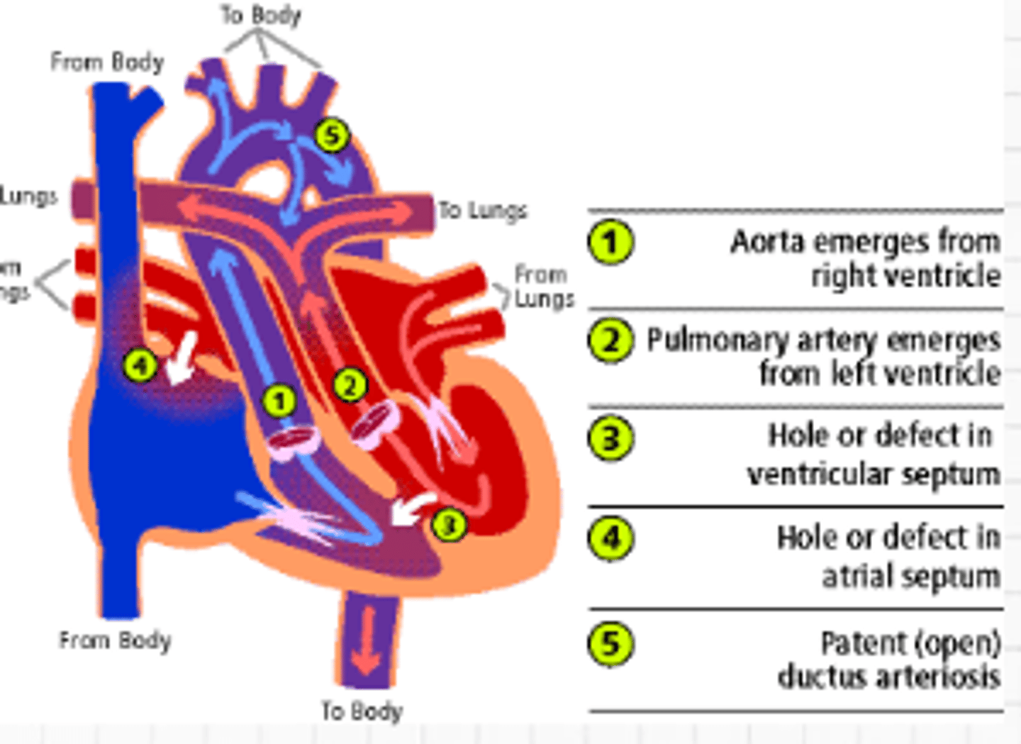 <p>This is a heart defect that occurs when the two main blood vessels leaving the heart are in abnormal positions. It is a life-threatening congenital condition</p><p>Aorta emerges from right ventricle</p><p>Pulmonary artery emerges from left ventricle</p><p>Hole or defect in ventricular septum</p><p>Hole in atrial septum</p><p>Patent Ductus arteriosus</p><p>Each side of the heart has its own circulation without communication.</p><p>Mixing of blood seen in ASD, VSD, PDA</p>