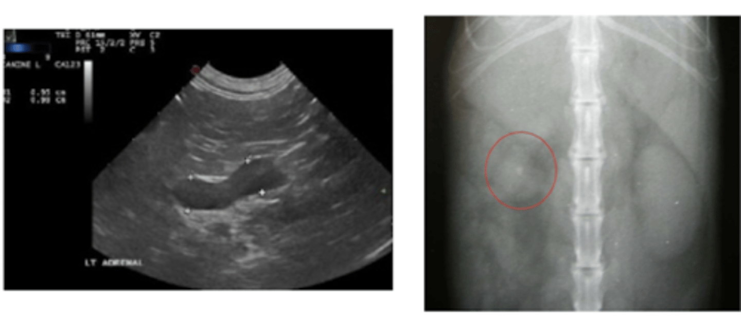 <p>RX: inespecífico</p><p>- ↑ contraste abd</p><p>- redistribución de grasa abd, hepatomegalia, distensión vesical</p><p>- masa/calcificación adrenal</p><p>eco: elección</p><p>- HAC primario: masa de la glándula afectada. atrofia de la gl. contralateral</p><p>- HAC secundario: ↑ tamaño ambas glándulas</p>