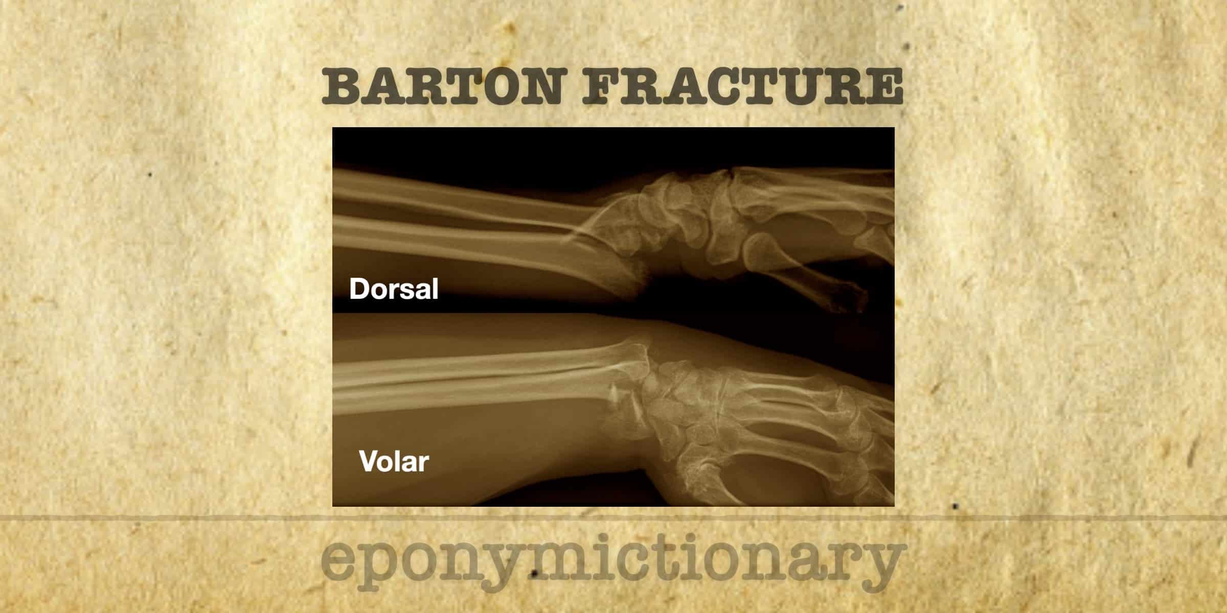 <p>falling on top of bent wrist, the distal radius breaks. can happen with direct impact to wrist also. can be described as volar or dorsal placement </p>
