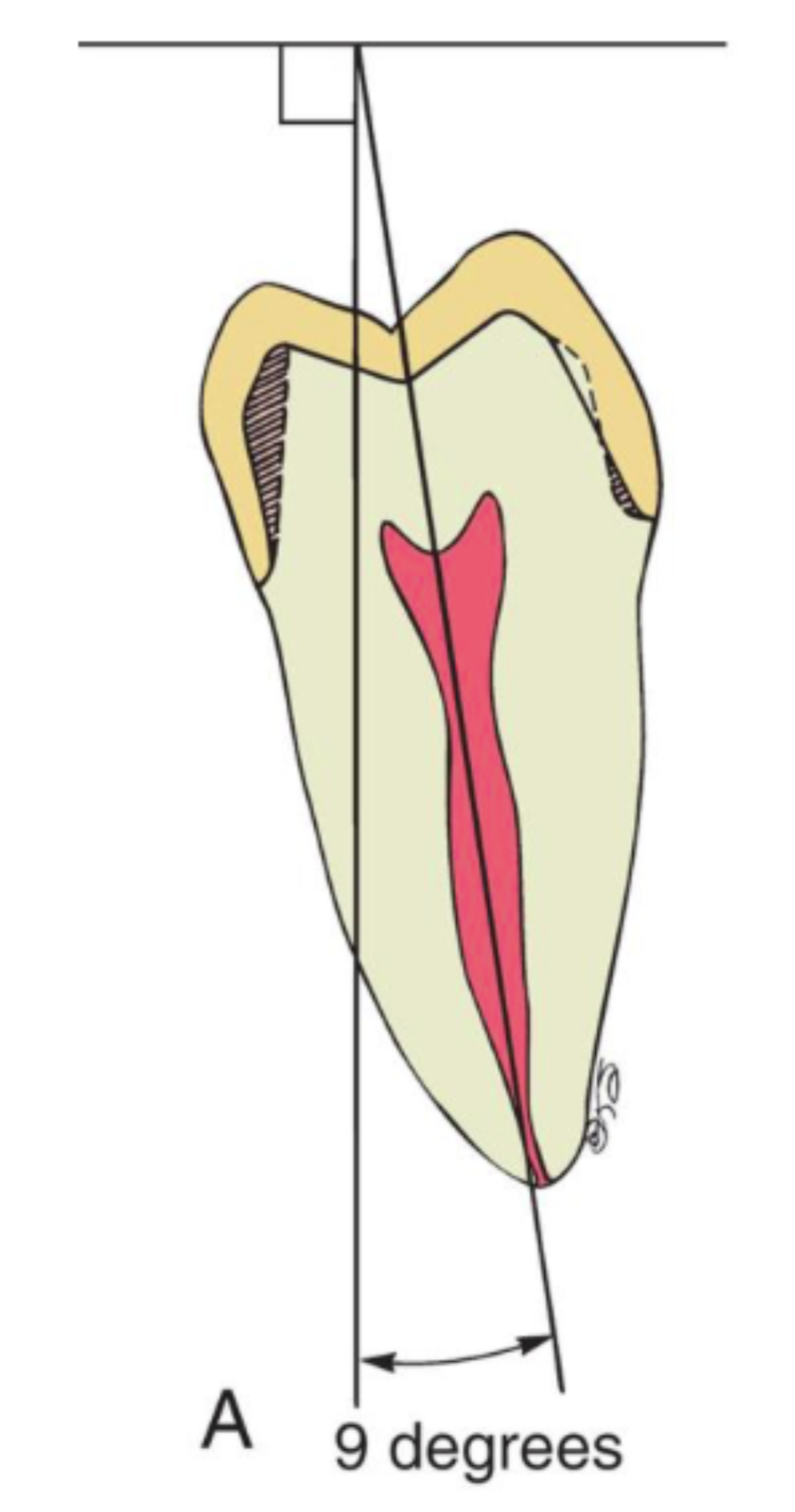 <p>9 to 14 degrees lingually → path of insertion should coincide w this how </p>