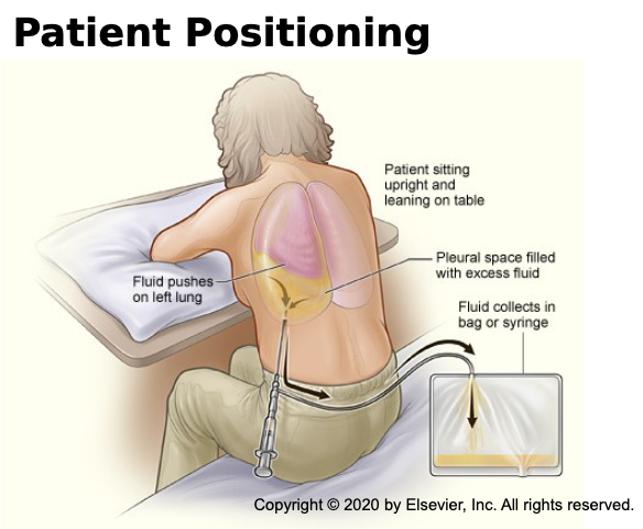 <ul><li><p>A less invasive way to remove pleural fluid</p></li><li><p>Used to remove small to moderate amounts of fluid from pleural space that cause breathing difficulties, provides immediate relief of symptoms and aids in diagnosis</p></li><li><p>Single one-time procedure</p></li><li><p>Diagnostic - analysis of fluid guide to treatment</p></li><li><p>Therapeutic - temporarily removes fluid and improves lung function (cirrhosis, cancer, heart failure)</p></li></ul><p></p>
