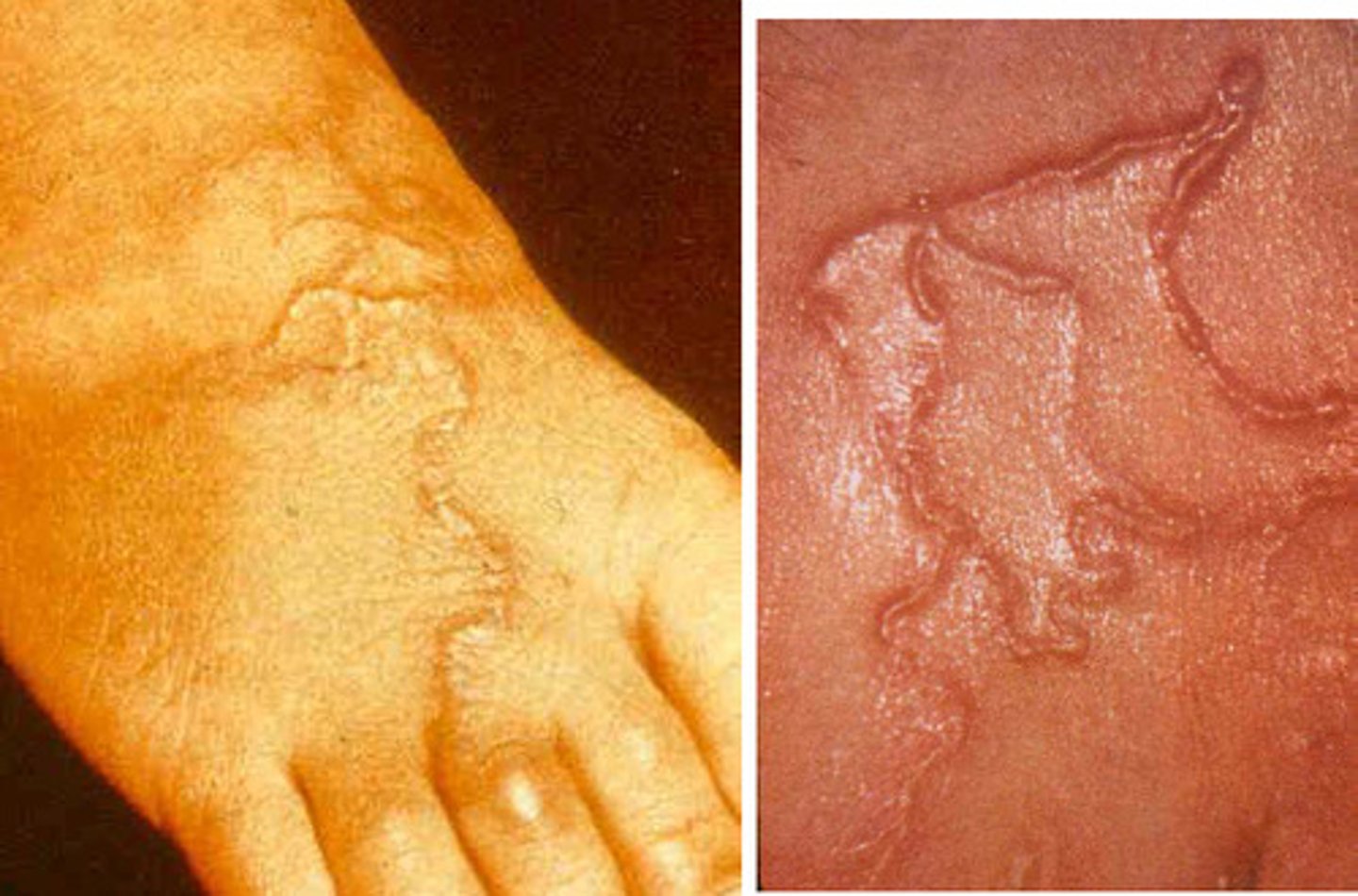 <p>Cutaneous larva migrans</p><p>- Ancylostoma braziliense, dog and cat hookworm</p>