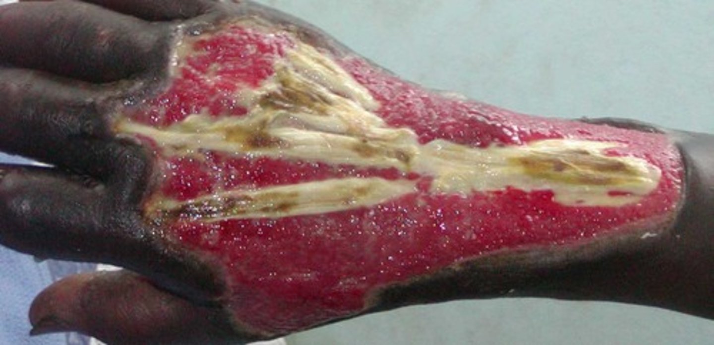 <p>Tissue damage caused by heat, electricity, radiation, certain chemicals.</p>