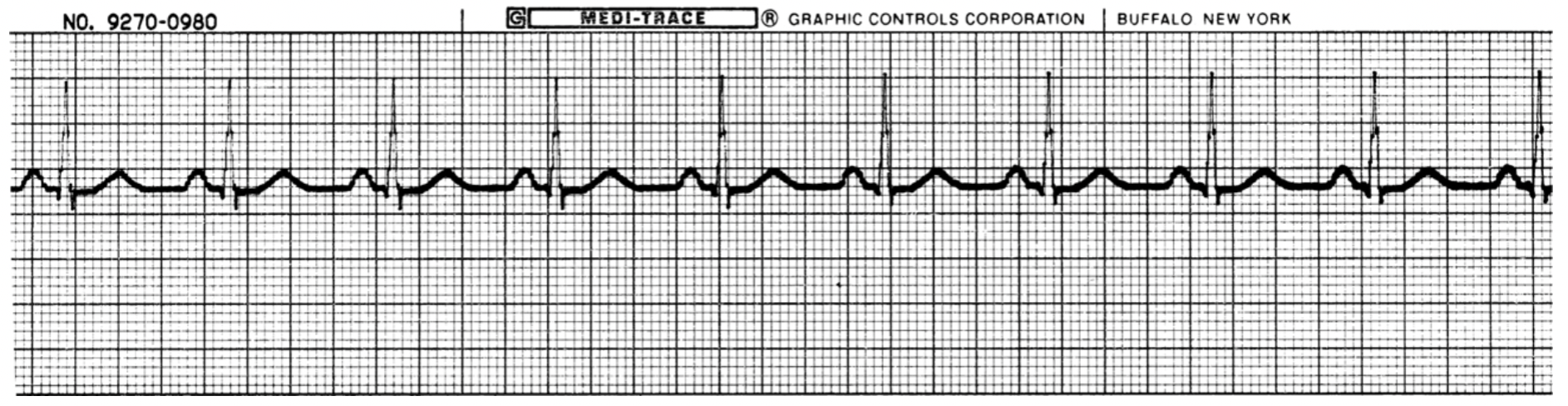 <p>What is the rhythm?</p>