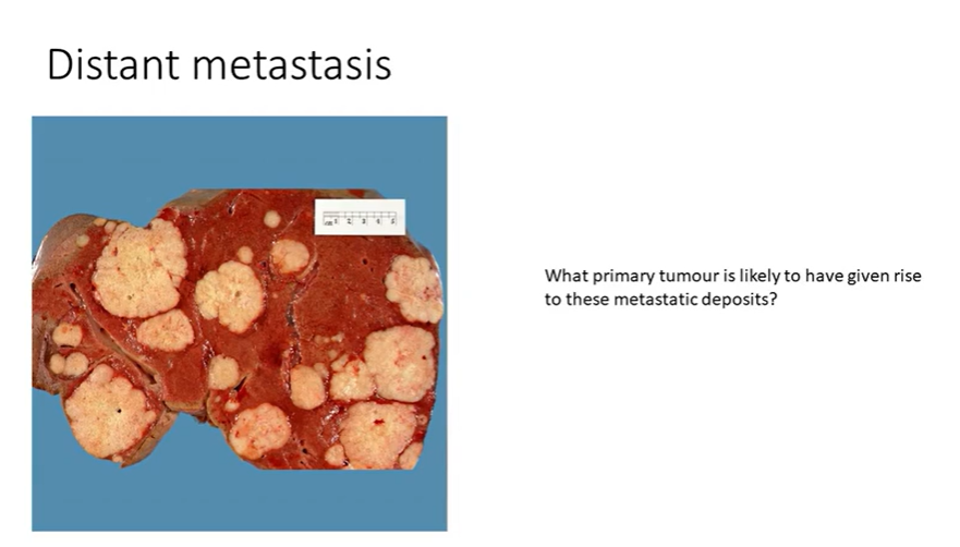 <ul><li><p>liver - probably a post-mortem sample</p></li><li><p>contains multiple white nodules - consistent with metastasis </p></li><li><p>disseminated picture - likely from somewhere else compared to a lone, primary tumour - usually GI, breast and lung </p></li></ul><p></p>