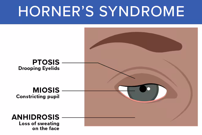 <ul><li><p>miosis</p></li><li><p>ptosis</p></li><li><p>facial anhidrosis</p></li></ul><p></p>