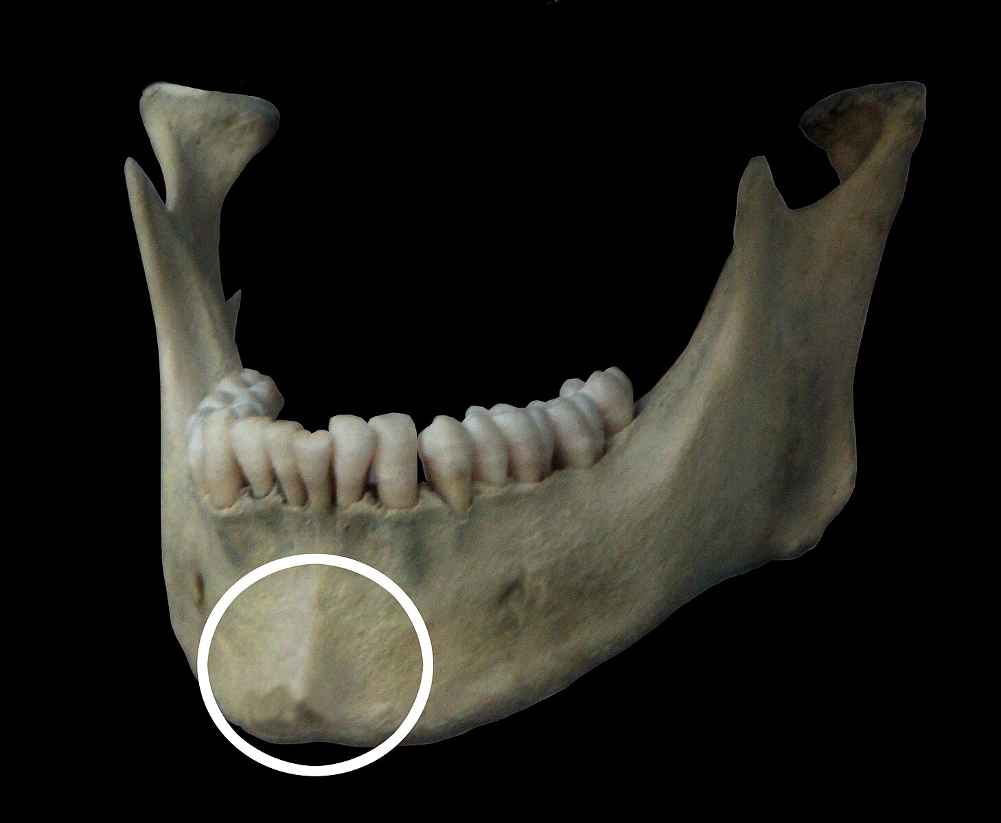 <p>What is the mental eminence used for (Buikstra and Ubelaker, 1994; Walker, 2008)?</p>