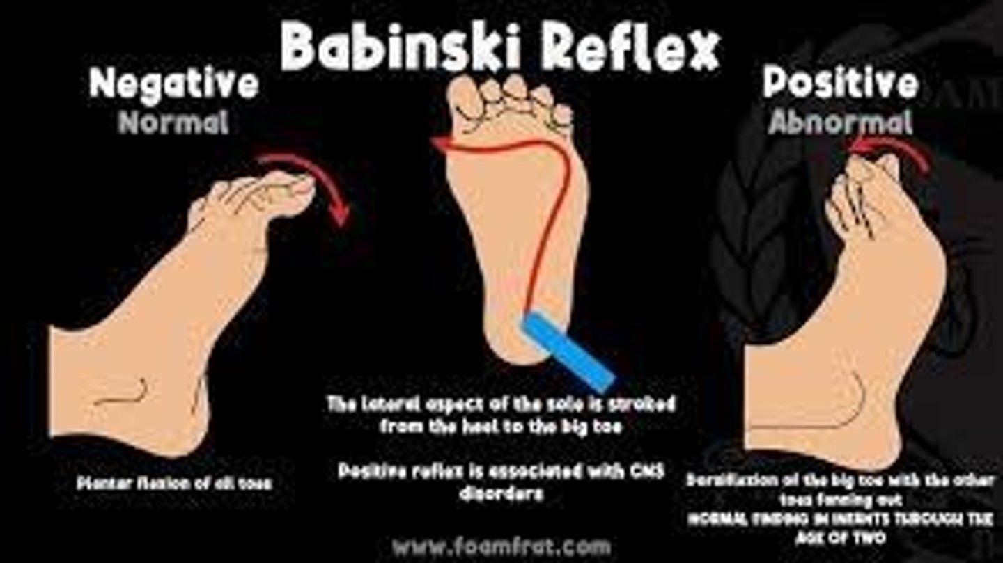 <p>- This is used to test for brain damage or upper motor neuron damage. It is considered positive if the toes flare up upon stroking the plantar aspect of the foot.</p>