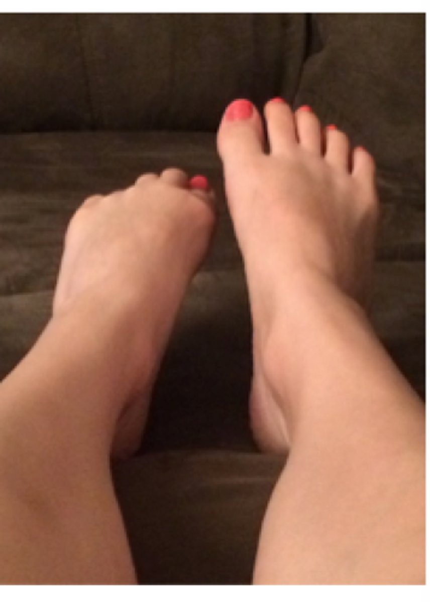 <p>the muscle in the calf of the leg tends to tighten, causing the toes to point down. May happen when the patient must remain in bed over a long period of time.</p>