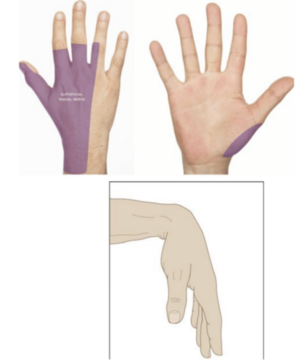 <p>wrist drop, weakness with finger extension of first and second digit, sensory loss at dorsal web +/- hyporeflexia</p>
