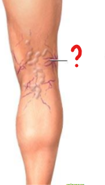 <p>What pathology is seen here?</p>
