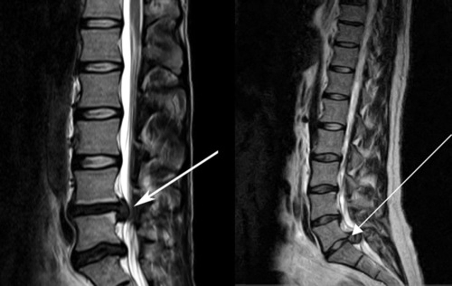<p>injury or herniated disk compresses cauda equina nerve roots, back pain, weakness, saddle anesthesia, incontinence</p><p>Tx- emergency surgical decompression</p>