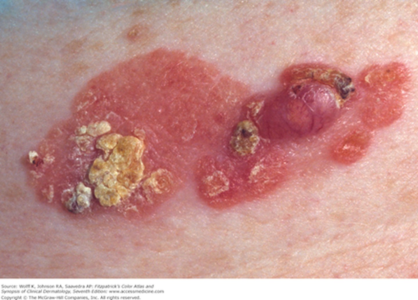 <p>-firm bump (nodule) on the skin (often in sun-exposed areas)</p><p>-scaly crust</p><p>-surgery for treatment</p>