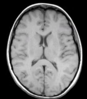 <p>Which type of CT contrast highlights fat and anatomy: <strong>fat is bright; water is dark?</strong></p>