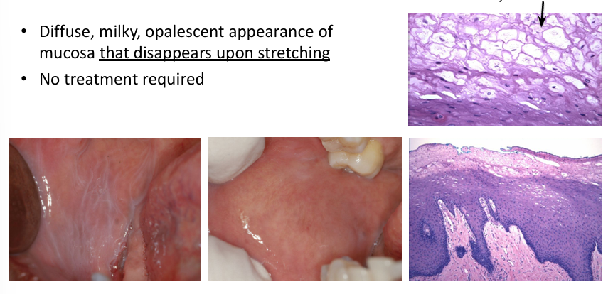 <p>-diffuse, milky, opalescent appearance of mucosa that disappears upon stretching</p><p>-no treatment required</p><p>-diffuse, milky grayish-white surface with folds, wrinkles, or streaks</p><p>-does not rub off but disappears when stretched</p><p>-bilateral buccal mucosa: may extend onto lips, floor of mouth, palatopharyngeal tissue</p>
