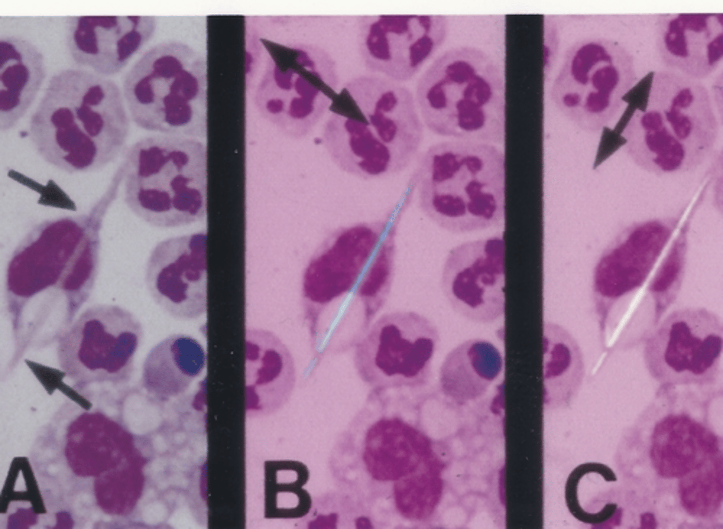 <p>Identify the crystals in this body fluid</p>