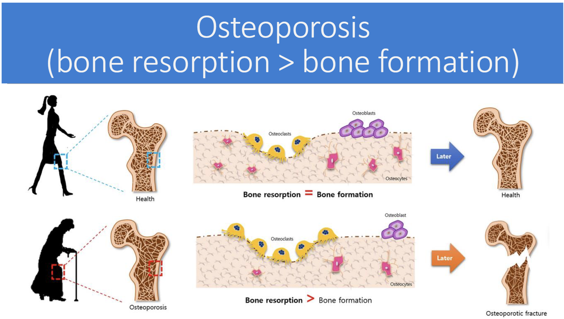 <p>Bone resorption(breakdown) > bone formation</p>