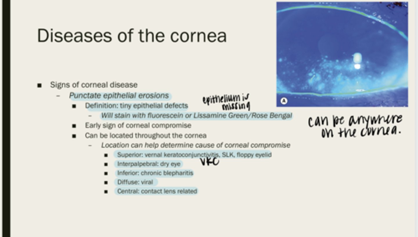 <p>Superior PEEs can be indicative of what diseases?</p>
