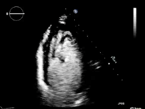 <p>Which of the following is a potential cause for the abnormal swirling appearance of the UEA on the video?</p>