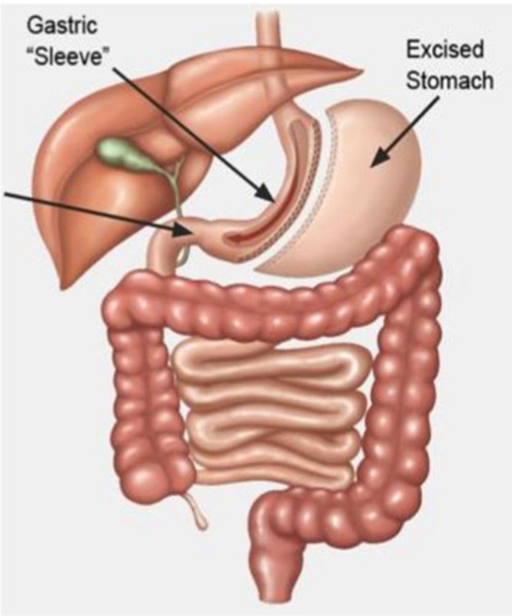 <p>- 70% of stomach is removed, leaving banana shaped tube</p><p>- irreversible; limited food intake</p><p>25-30% weight loss from baseline</p>